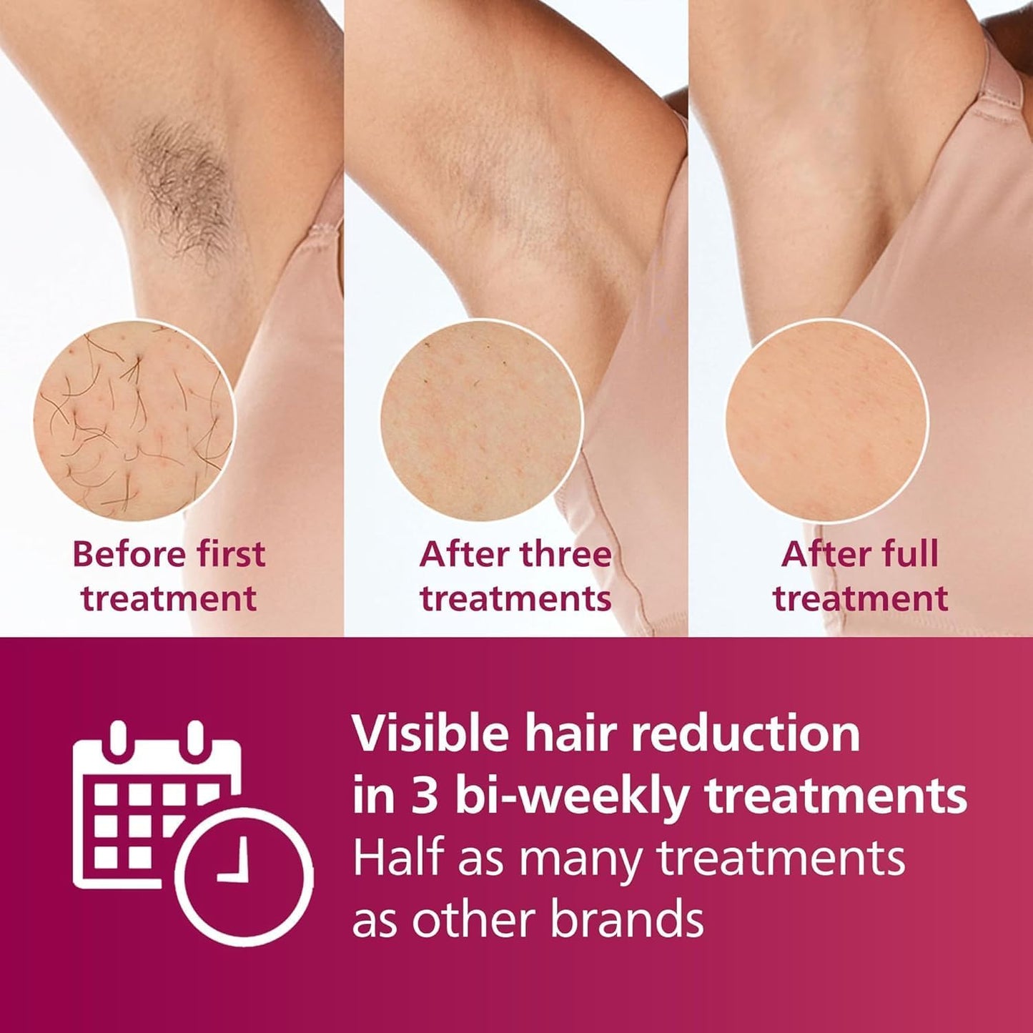 Philips Lumea IPL Hair Removal Device (AU Power Plug) for Men and Women - New Condition